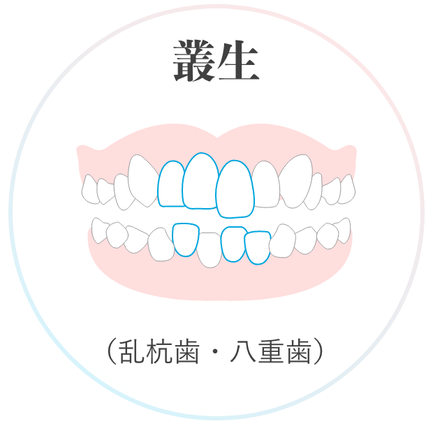 叢生 （乱杭歯・八重歯）
