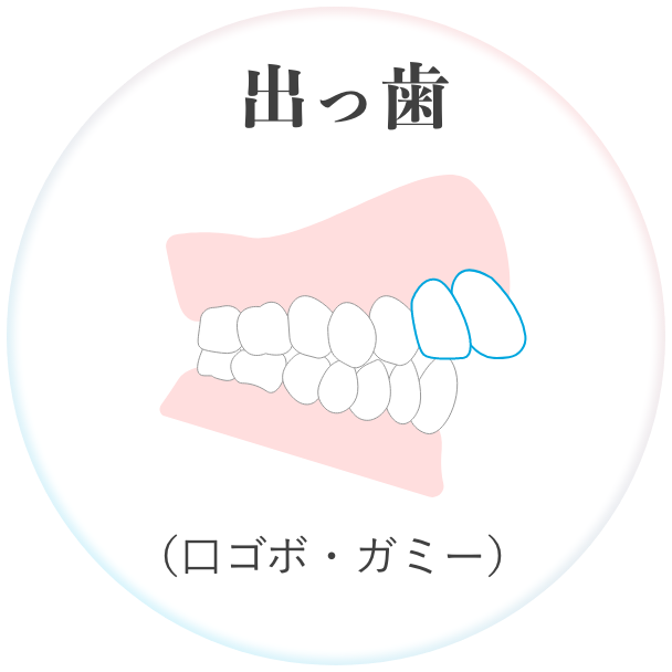 出っ歯 （口ゴボ・ガミー）