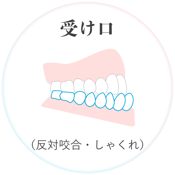 受け口 （反対咬合・しゃくれ）