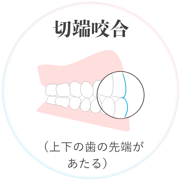 切端咬合 （上下の歯の先端が あたる）