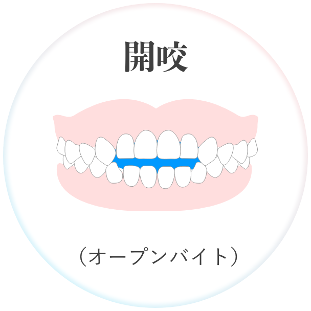 開咬 （オープンバイト）