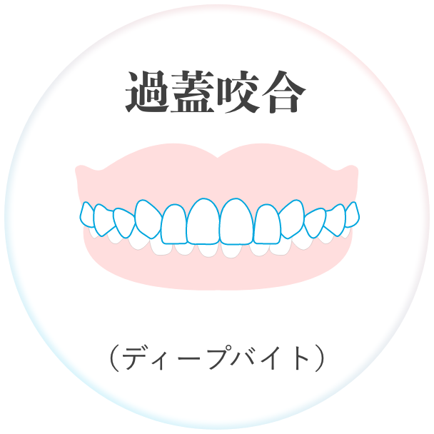 過蓋咬合 （ディープバイト）