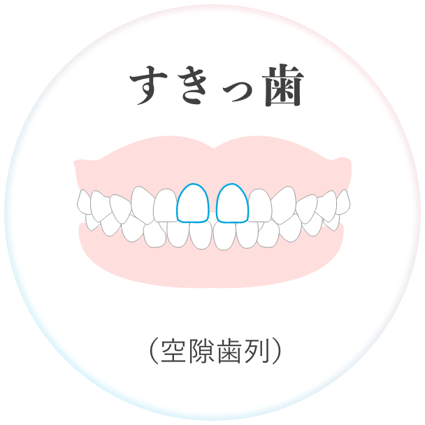 すきっ歯 （空隙歯列）