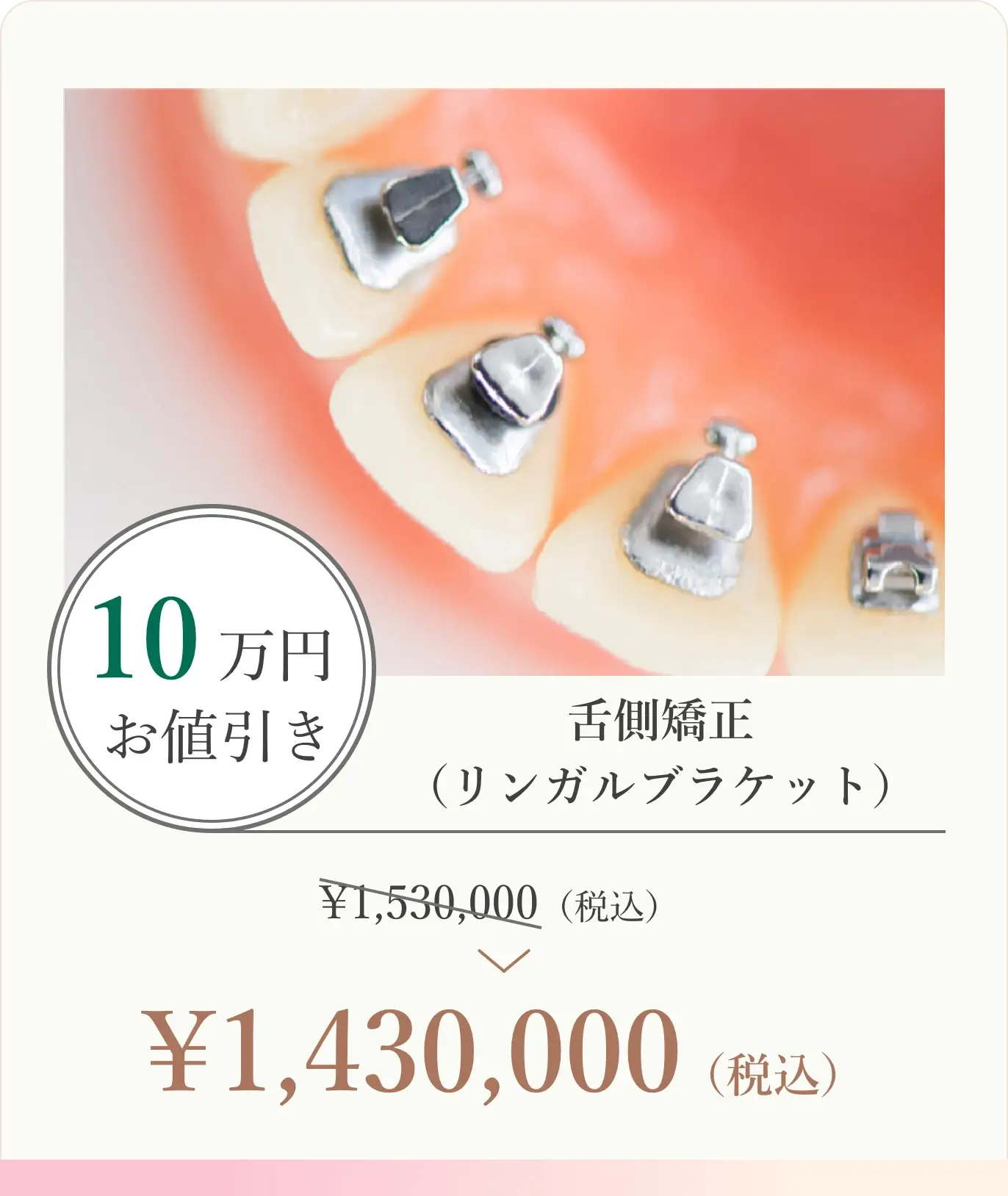 10万円お値引き！舌側矯正 （リンガルブラケット）1,530,000円（税込）が1,430,000円（税込）に