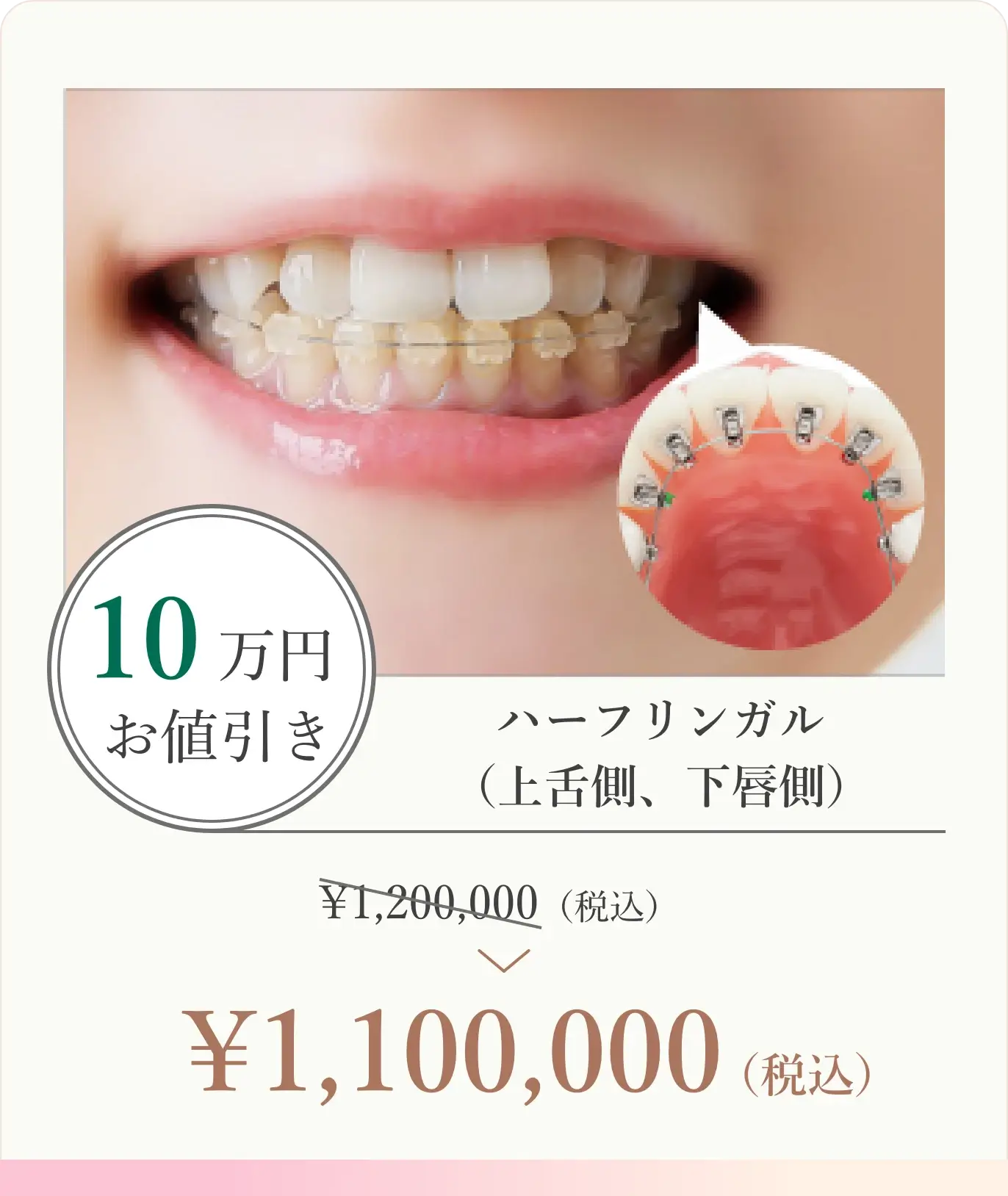 10万円お値引き！ハーフリンガル （上舌側、下唇側）1,200,000円（税込）が1,100,000円（税込）に