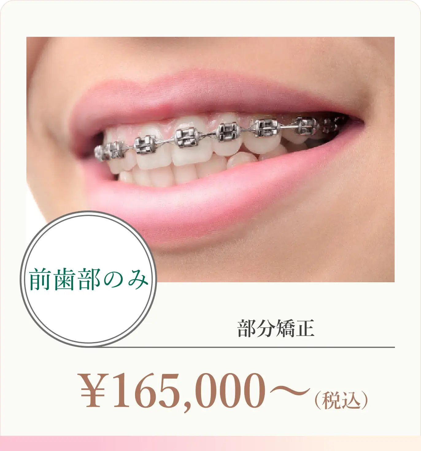 前歯部のみ 部分矯正165,000円（税込）〜